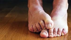 Claw toes can develop in many people as they age, and can make fitting into restrictive shoes uncomfortable. 5 Ways To Soothe Bunion Pain Without Surgery Optima Foot And Ankle Podiatrists