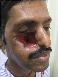 In india in the second. Cranio Facial Mucormycosis The Plastic Surgeon S Perspective Springerlink