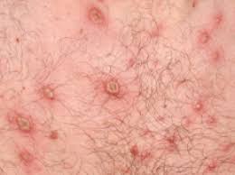 Image result for Skin Infection