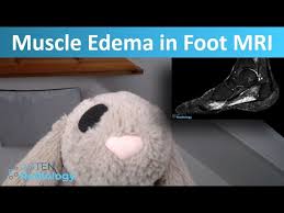 Maybe you would like to learn more about one of these? Foot Mri Muscle Edema Youtube