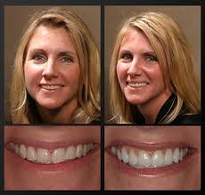 Come to try teeth whitener to brighten your smile now! Teeth Whitening Rochester Mi G L O Whitening System