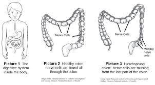 Definition of colon (entry 2 of 5). Hirschsprung Disease Hd