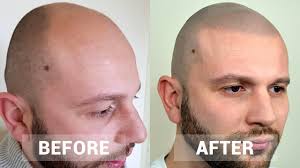 The procedure is most commonly referred to as scalp micropigmentation (smp) where a skilled practitioner tattoos micro dots to resemble natural hair follicles. Hairline Inc Uk Leaders In Scalp Micropigmentation