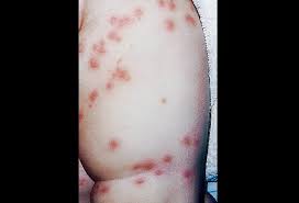 Check spelling or type a new query. Bites And Infestations Pictures Of Bug Bites Stings Allergies And Infections