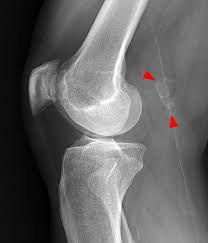 Image result for Prepatellar Bursa Injection