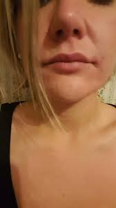 5 mm Upper &amp; Lower Surgisil Permalip