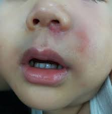È noto formalmente come sindrome della pelle scottata da stafilococco. Staphylococcus Aureus Infezione Da Stafilococco