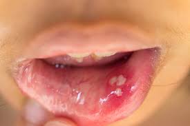 Image result for Canker sores symptoms roof of the mouth
