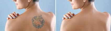 The total number of laser tattoo removal sessions you will require depends the type of tattoo, and is influenced by factors such as: Laser Tattoo Removal Launceston Victoria S Cosmetic Medical Clinic