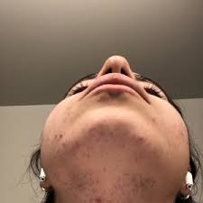 The skin may feel tender and you might notice redness, irritation, and swelling. Laser Hair Removal Reviews Was It Worth It Realself