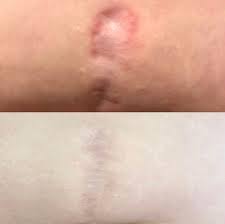 This condition refers to the inability to control one's urination. Inkoff Me 15 Photos 82 Reviews Laser Hair Removal 5534 Elvas Ave Sacramento Ca United States Phone Number