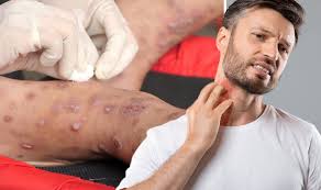 Image result for scabies on genitals