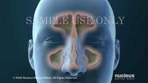Image result for Sinus Surgery