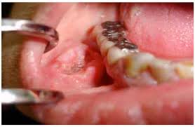 Image result for spinocellular carcinoma of the oral cavity
