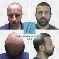 Before After Sacekimi Sacekimioncesi Sacekimisonrasi Sacsagligi Drserkanaygin Sacekimiuzmani Sacekimmerkezi Hair Hair Transplant Hair Movie Posters