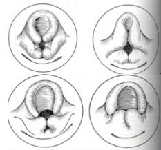When your child has laryngomalacia. Estudio Sobre Laringomalacia En Pediatria Sepeap Sociedad Espanola De Pediatria Extrahospitalaria Y Atencion Primaria