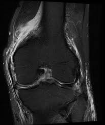 Webmd's knee anatomy page provides a detailed image and definition of the knee and. Medial Supporting Structures Of The Knee With Emphasis On The Medial Collateral Ligament Radsource