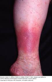Dacă doriţi, vă pot asista de la faţa locului. Dermatitis Pigmentosa An Ankle Wasatchpremiermovers Com