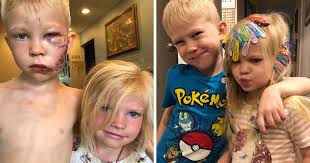 Vendredi soir, un petit garçon a été hospitalisé après avoir été mordu au visage par un chien à son domicile familial. Un Garcon De 6 Ans A Ete Accueilli En Heros Apres Avoir Sauve Sa Petite Soeur D Une Attaque De Chien Ipnoze