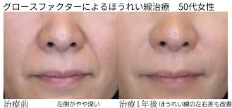 片側 だけ ほう れい 線