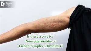 Image result for Neurodermatitis