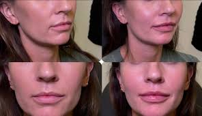 One syringe enhancement for this first time client💋💉 #lipfiller #versa  #revanesselips #revanesseversa #aestheticinjector