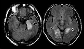 This is the first study that compared the serum sodium levels. Case Report