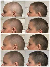 Scalp cooling appears to be most effective when combined with chemotherapy drugs such as anthracyclines such as adriamycin (doxorubicine), and taxanes, such as taxol (paclitaxel). Pin On Hair