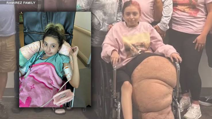 Florida teen undergoes 17-hour surgery at Johns Hopkins to remove 174-pound  leg