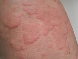 Keflex should be used with caution in patients who have kidney disease and those who report a history of penicillin allergy. Cutaneous Adverse Reactions To Antibiotics Dermnet Nz