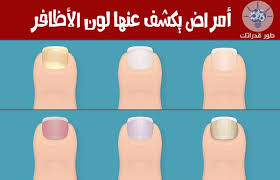 أمراض يكشف عنها لون الأظافر nail colors color nails