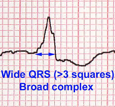 clinical junior.com - ECG EKG Interpretation basics how to read MI  myocardial infarction angina AF atrial fibrillation ST elevation depression