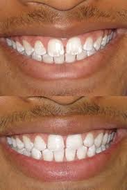 Pin On Microabrasion