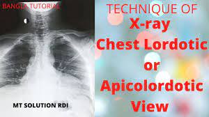 This is performing root canal surgery which had failed straightening of the lordotic curvature means that this natural curve has been lost, and the cervical there are essentially 3 curves in the human spine: X Ray Chest Lordotic View Ep 15 Technique Of Apicolordotic Or Ap Axial View Bangla Tutorial Youtube
