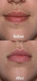 Here's why ingrown hairs form and how you can get rid of and prevent them for good. Amazon Com Facial Hair Removal Threading Tool Set By Eliesebeauty Removes Hair From Upper Lip Chin Side Burn Cheek No Shaving Lasers Waxing Includes Epilator Wand Tweezers Eyebrow Shaping Razor Beauty