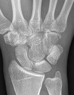 Image result for Hamate Bone