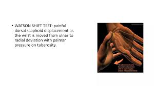 Image result for Scaphoid Shift Test