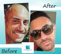 Hair Transplantation