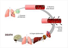 However, it is not known how early rbc abnormalities are expressed compared with various clinical manifestations used in. Sepsis Stages