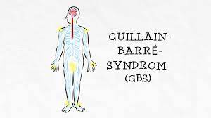Barre syndrome as a cause of acute flaccid. Informationsmaterial Gbs Initiative