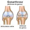 Arthrose, gelenkverschleiß allgemein hüftgelenksarthrose, arthrose des hüftgelenks kniegelenksarthrose, arthrose des kniegelenks. 1