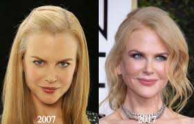 Nicole Kidman Plastic Surgery