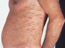 Pityriasis rosea, a rash that usually appears on the torso, upper arms, thighs or neck, may sound pityriasis rosea starts with a single patch on your back or torso. Pityriasis Rosea Altmeyers Encyclopedia Department Dermatology