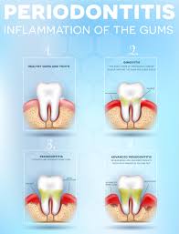 Where bone loss has occurred, they have the skills and knowledge to provide the treatment you bone grafting is a frequent component of periodontal surgical procedures. Celebrate National Gum Care Month And Avoid Gum Disease