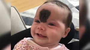 Baby's birthmark surgery fund raises £25,000