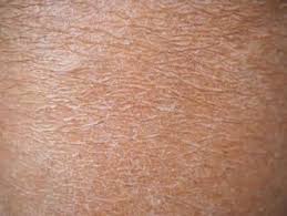 Image result for Dry Skin