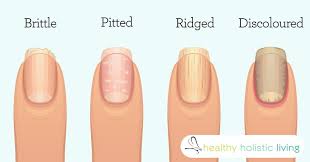 By Jesse Cannone Fingernails And Disease Don T Go Together In Most Minds But They Should Your Fingernails Can Fingernail Health Nail Health Nail Health Signs