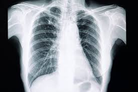 Cos'è la fibrosi polmonare idiopatica? Avances Prometedores Para Revertir Y Curar La Fibrosis Pulmonar