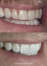 However, don't put a comma after the main clause when a dependent (subordinate) clause follows it (except for cases of extreme contrast). Tooth Veneers Before And After Smiles With Less Drilling