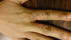 Usually there are no blisters. Ikea Customers Get First Degree Burns After Hand Sanitiser Refilled With Drain Cleaner Dutchreview